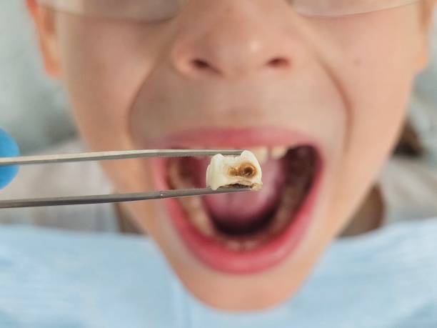 Best Emergency Dental Care for Broken or Chipped Teeth in Fairfax, MN