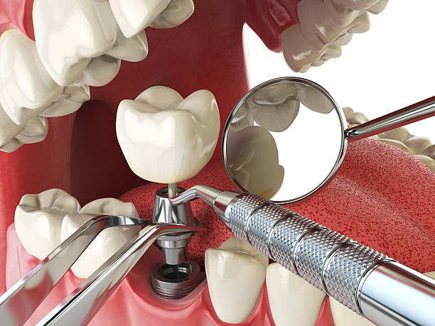 Best Emergency Tooth Extraction in Fairfax, MN